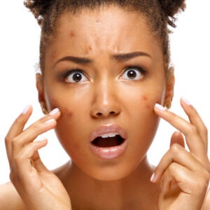 BioMedical Acne Facial & Peel